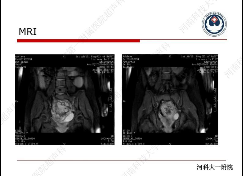 下腹疼痛原因及其治疗,下腹部疼痛持续一年了