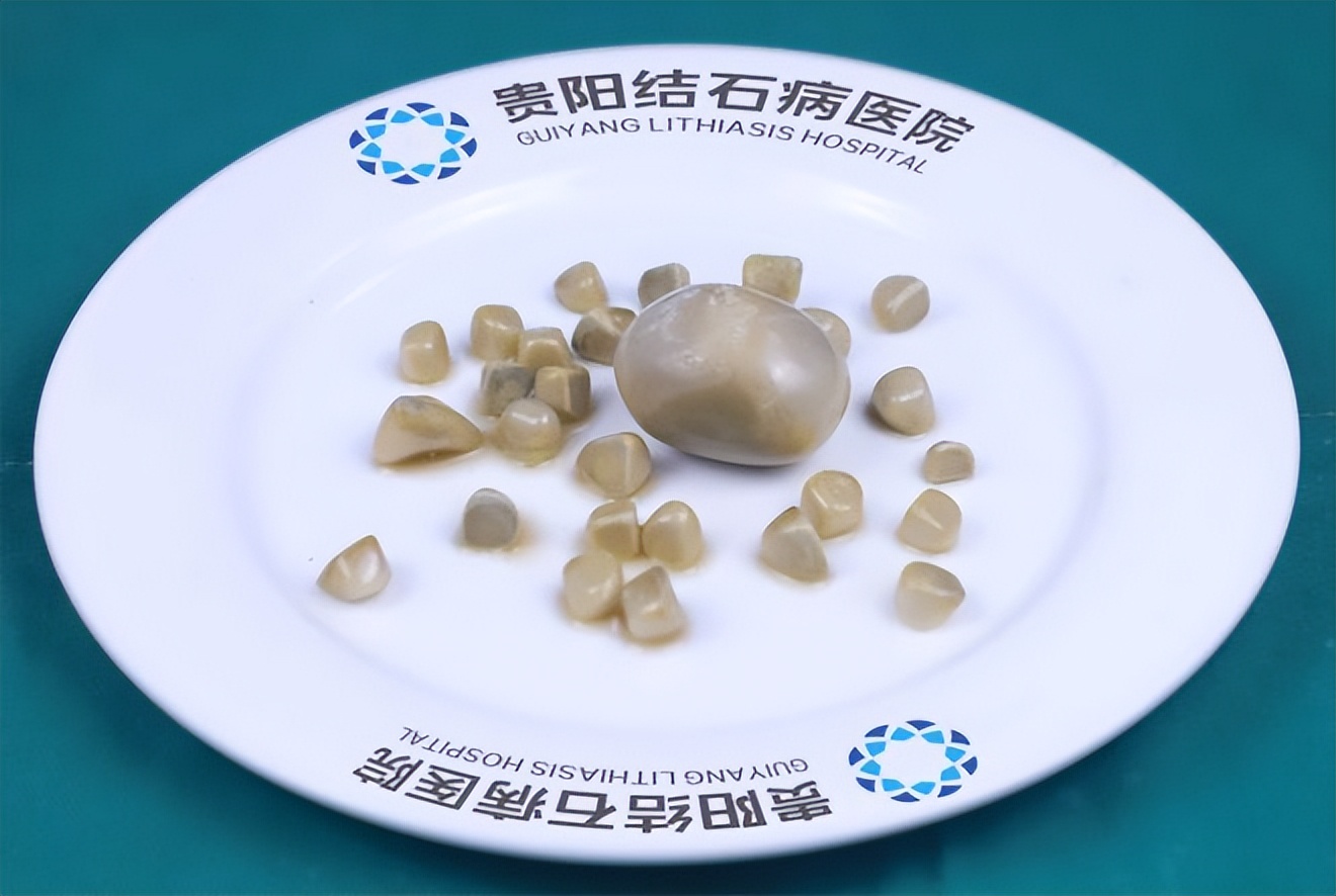 胆囊结石一般是什么色,胆囊结石的形状像米粒