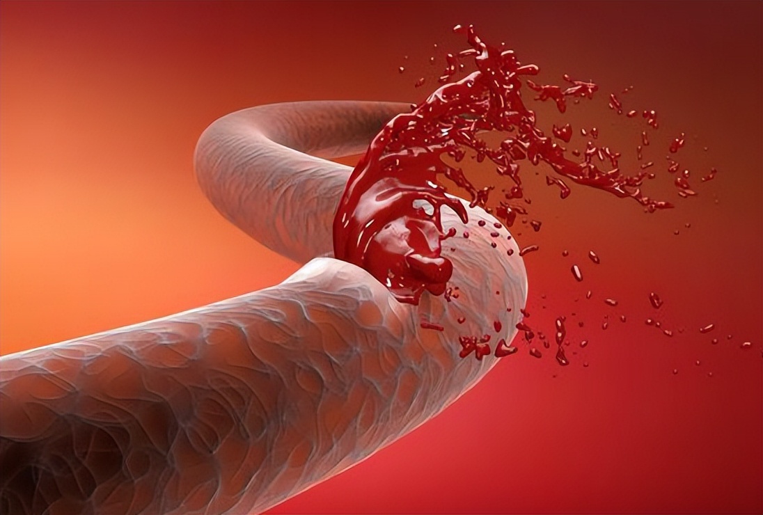 介入治疗后发烧怎么解决,做介入后发烧多久是正常的