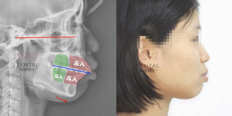 骨性龅牙怎么通过普通的矫正改善,骨钉如何解决骨性龅牙