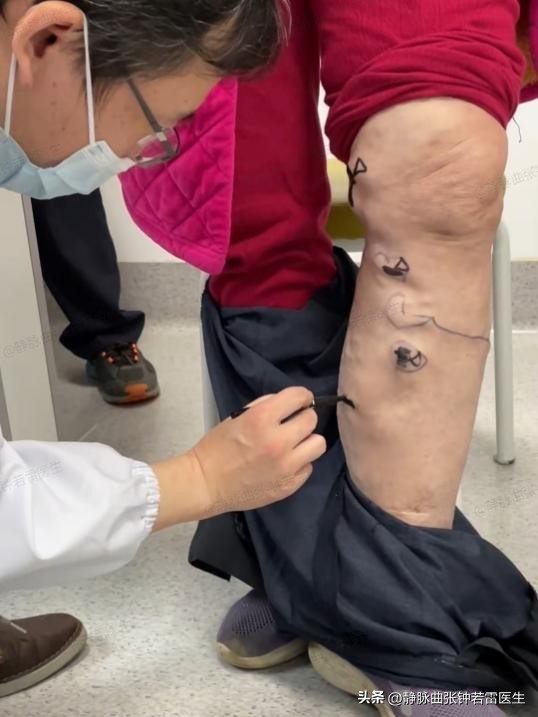 腿弯处有许多红色血管凸起,老年人腿部血管凸起