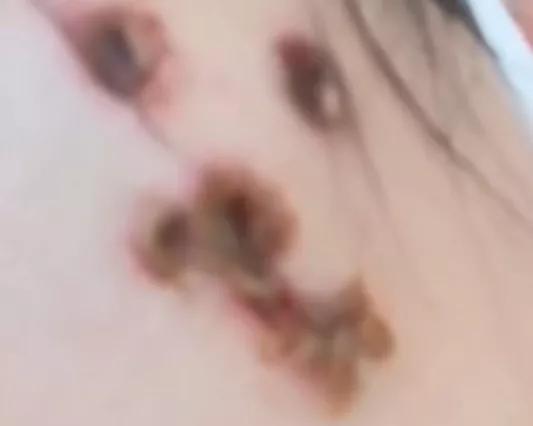 药水点痣烧伤,用药水点痣后留下的红疤怎么去除