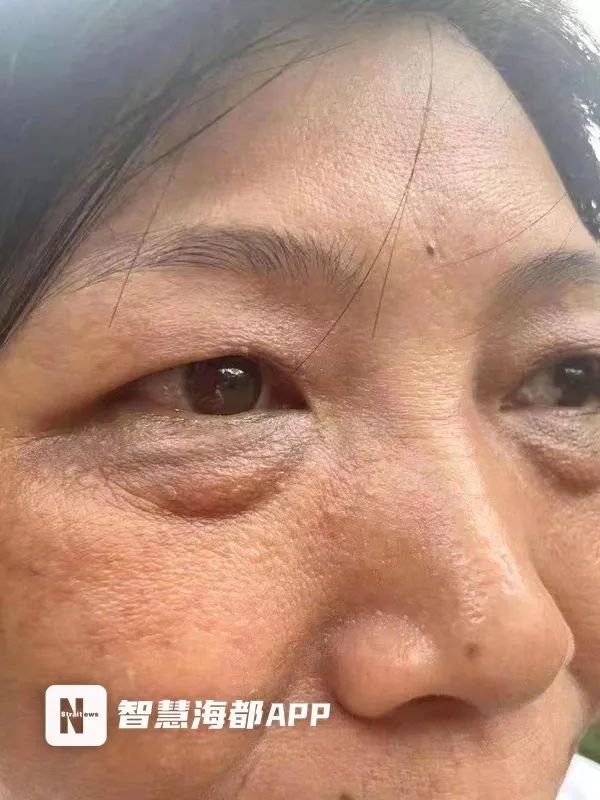 福州医美中介水太深，“闺蜜”介绍手术，发票价与实际花费差十倍