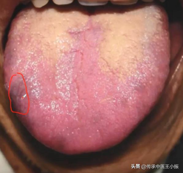 舌头瘀紫有青筋吃啥药,舌下青筋两边有瘀斑图片