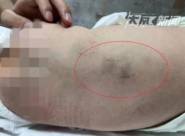 婴儿被护士拍打后续,婴儿被拍打致脑出血