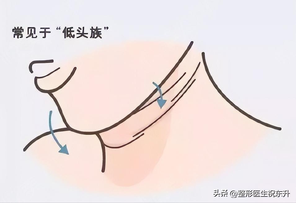 不让颈纹出卖年龄3招有效防颈纹,颈纹太深了怎么消除