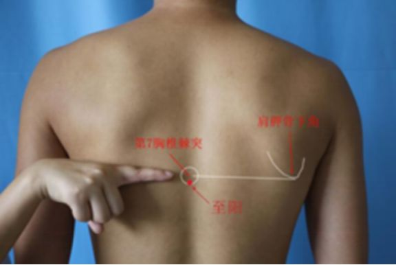谷医堂保健品,谷医堂扶阳罐