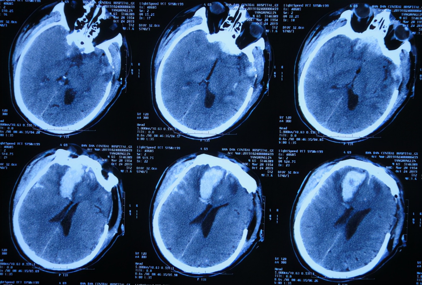 脑外伤后硬膜下积液颅骨修补,颅骨修复手术失败导致脑积水