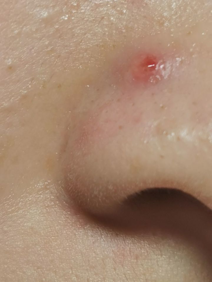 20年的黑头有多大,世界上最长的黑头到底有多长