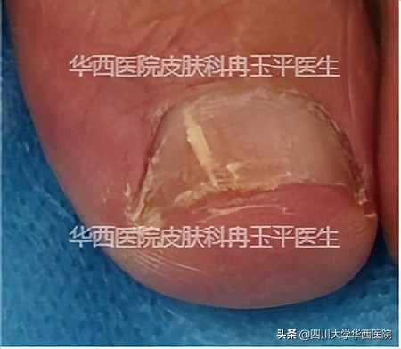灰指甲到底算什么病,指甲黄是不是灰指甲