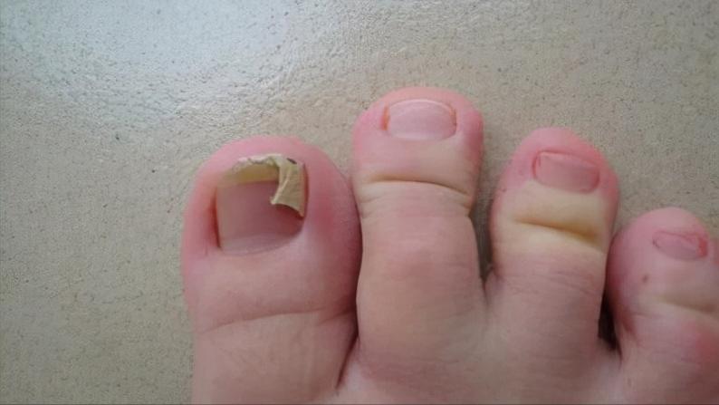 指甲往肉里长怎么办,指甲老往肉里钻