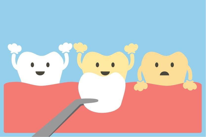 牙齿贴面属于美白还是修复,什么是牙齿贴面