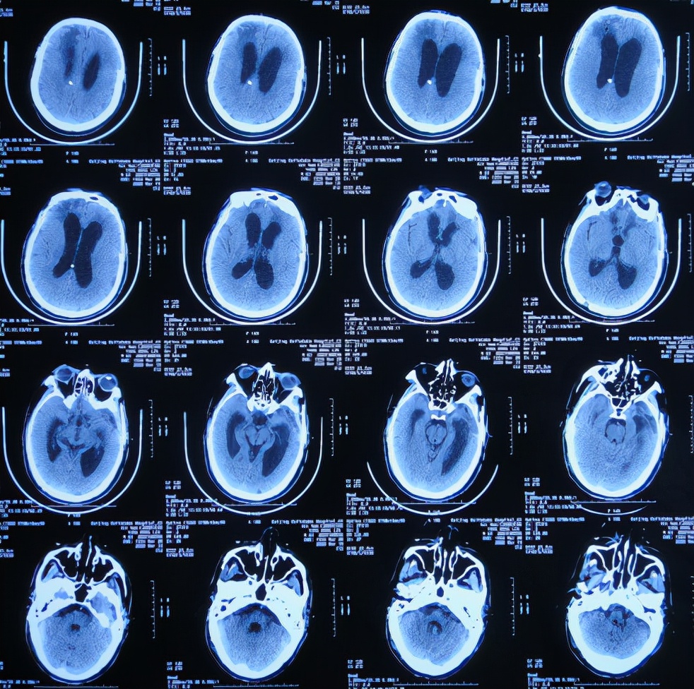 脑外伤后硬膜下积液颅骨修补,颅骨修复手术失败导致脑积水