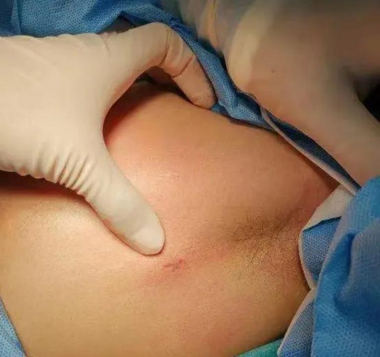 手心出汗是怎么回事怎样治疗,手汗症出汗特别严重用什么能止汗