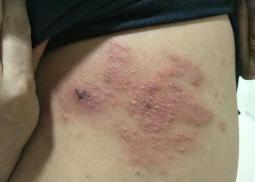 肝经湿热型带状疱疹一定要打针吗,带状疱疹肝经疼痛中药治疗