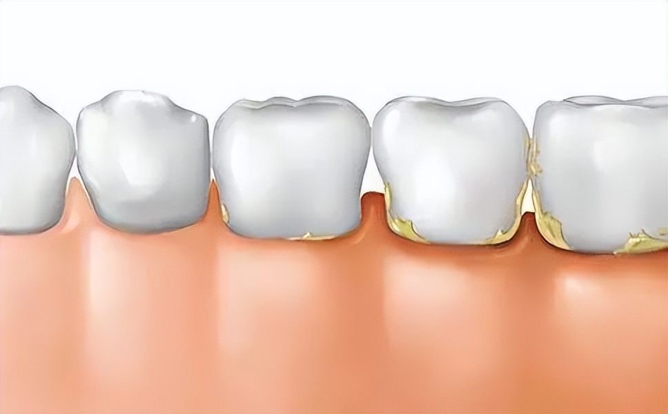 每天刷牙牙齿还是发黄是怎么回事,牙齿刷牙每天都出血怎么解决