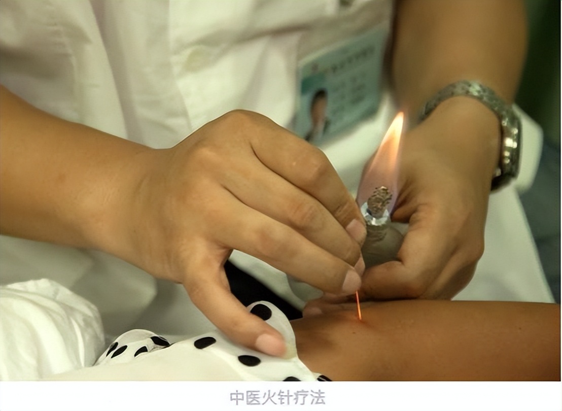 中风并发症会增加病死率，中医特色疗法针灸治疗效果如何？