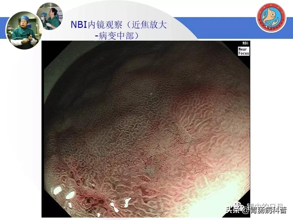 胃癌可以做内镜手术吗,早期胃癌内镜手术后追加外科手术