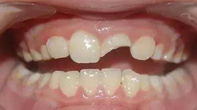 大牙崩掉一小块怎么办,补过的牙侧面被崩掉了一块怎么办