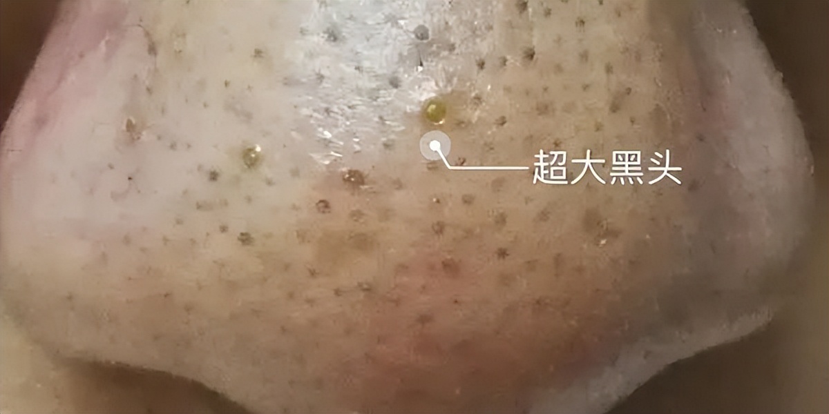 美容院清洁黑头会让毛孔变大吗,黑头拔了毛孔变大会自己愈合吗
