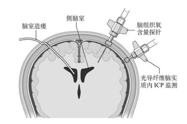 脑水肿压迫神经恢复要多久,脑水肿的诊断与治疗