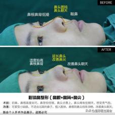 隆鼻后为什么没用夹板,隆鼻后鼻头感觉有点歪怎么办