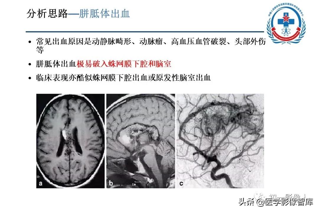 胼胝体变性治疗方法,原发性胼胝体病变治疗