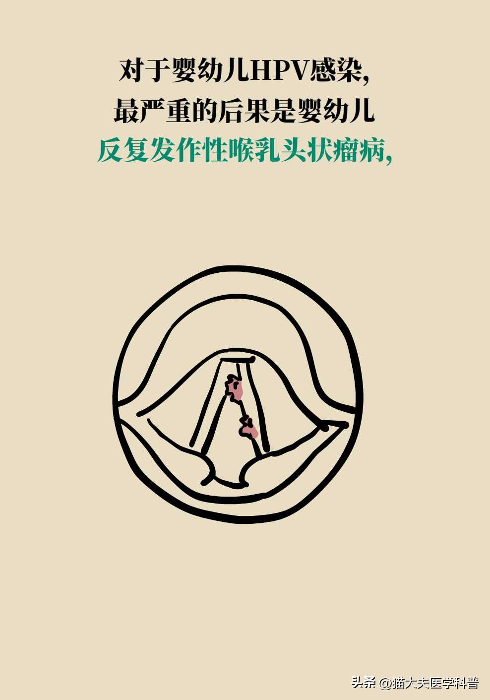 孕期感染了hpv怎么办,孕期长了丝状疣确定hpv感染吗