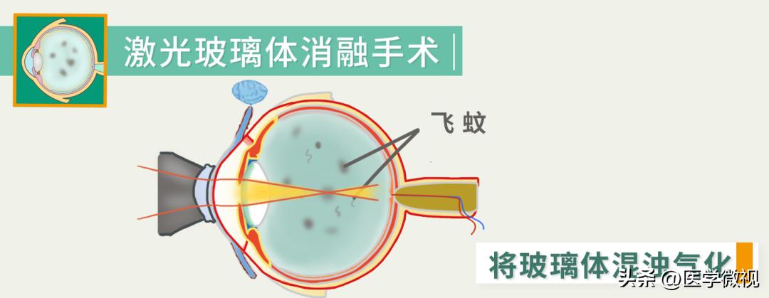 总感觉眼前有虫子在飞什么原因,老是觉得眼前有小飞虫在飞