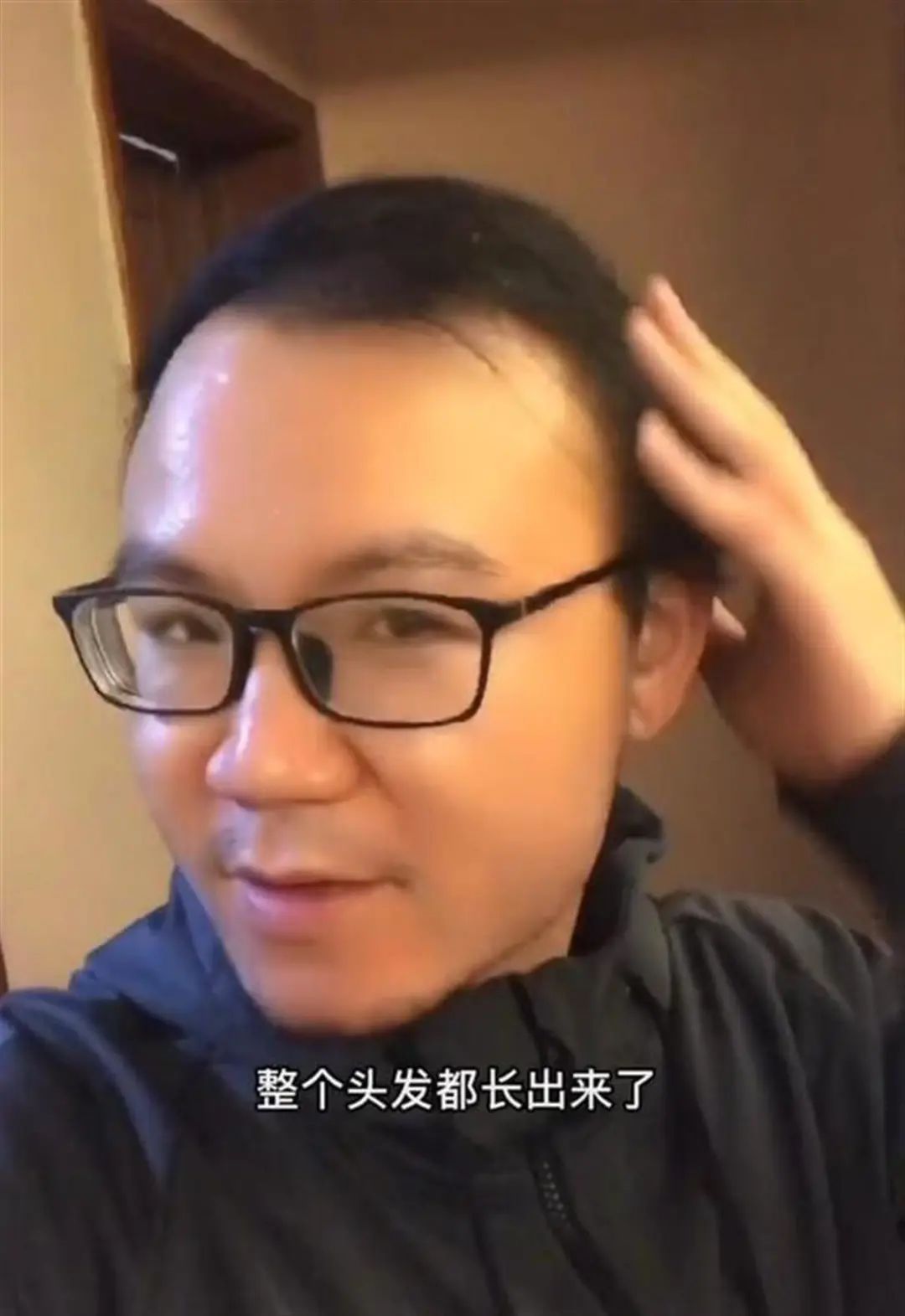 秃顶男子回应不用洗发水长出头发,男子秃顶半月不用洗发水