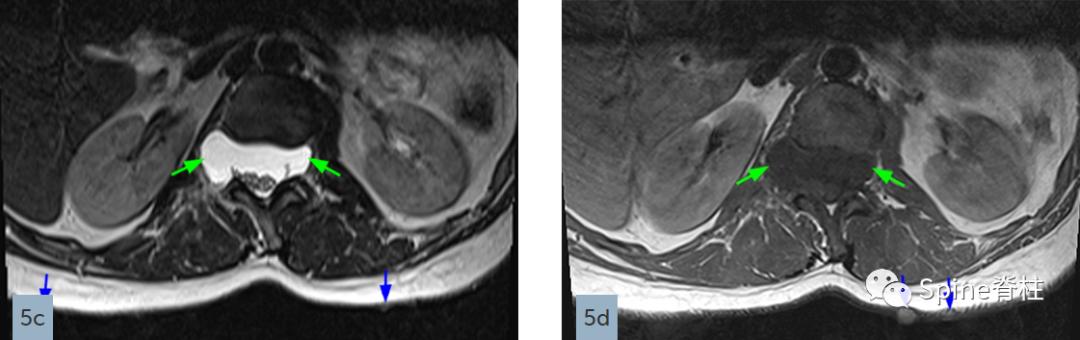 硬膜扩张,duralectasia