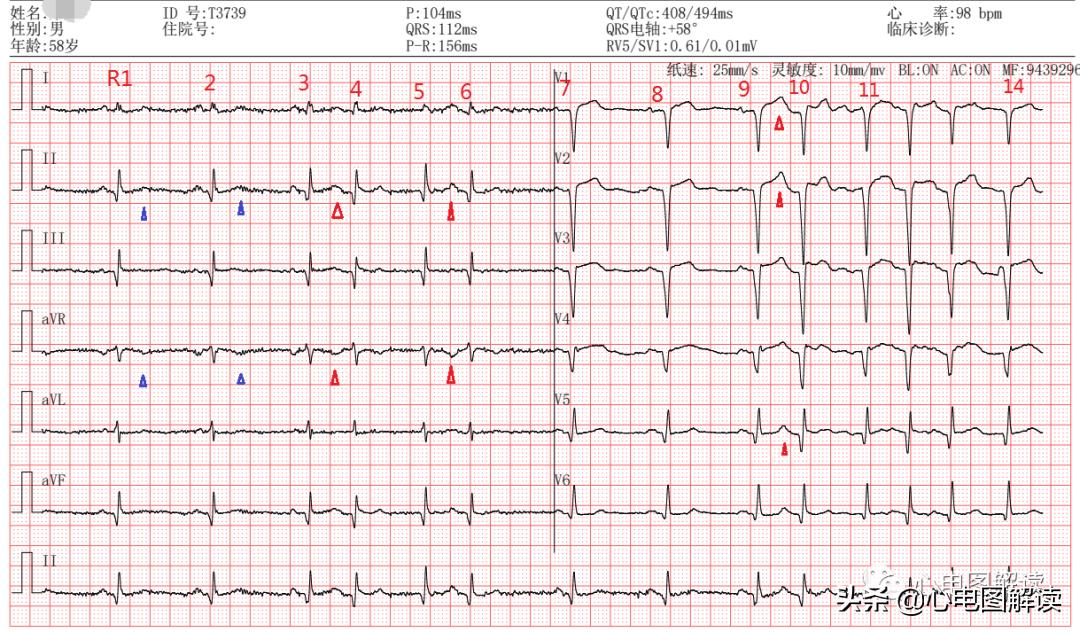 心房颤动三大临床表现,心房颤动的症状视频