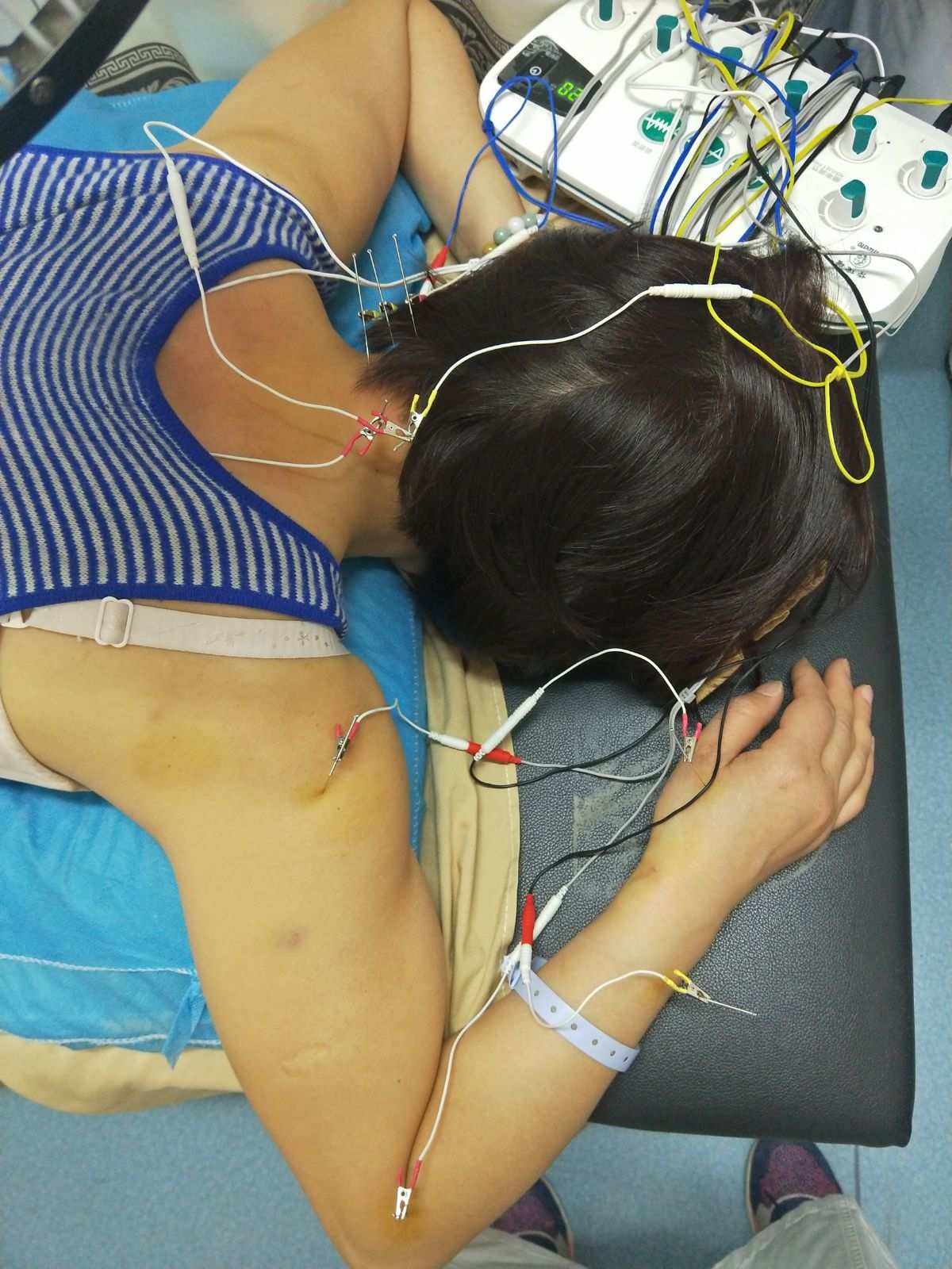 中医扎针治疗偏头痛,夹脊脉冲电针疗法