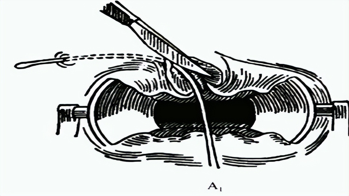 肛瘘患者:“不想治了,我真的太痛了!”肛瘘手术到底有多痛?