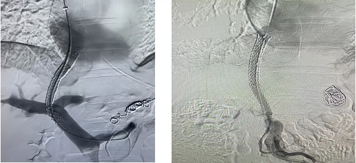 上消化道出血病人抢救,消化道出血病人的护理个案