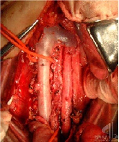 腺癌的症状和前兆,转移性腺癌属于什么癌症