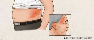 疱疹水泡下去了还很痛怎么办