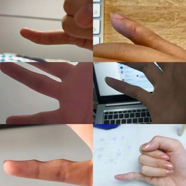 玩手机时间长了小拇指变形,玩手机小拇指变形