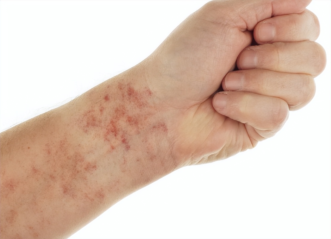 宝妈支气管发炎怎么办,宝妈得了支原体肺炎怎么办