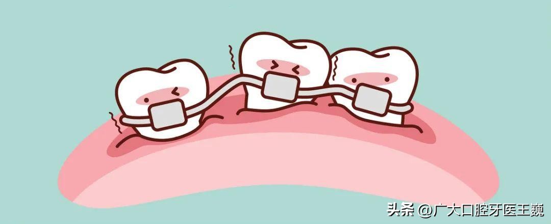 牙齿正畸矫正一般需要多久,正畸科普牙齿矫正的年龄限制问题