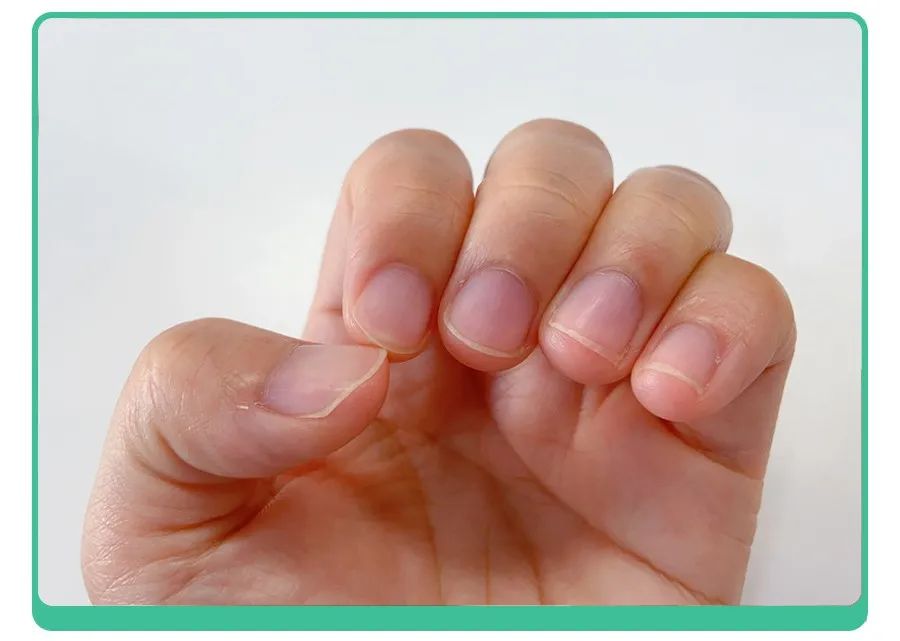 小孩指甲凹陷变黑有坑是什么原因,小孩指甲有白点和细纹是怎么回事