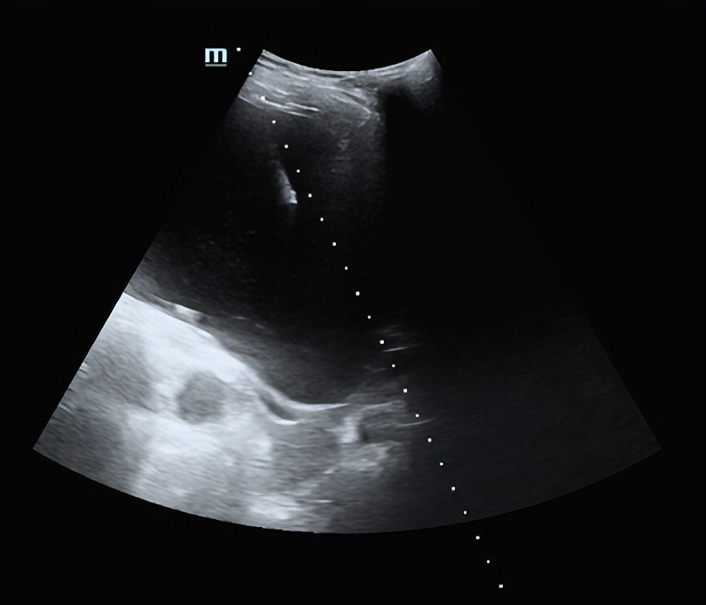 专家讲解多发肝囊肿治疗视频,多发性肝囊肿适合什么手术