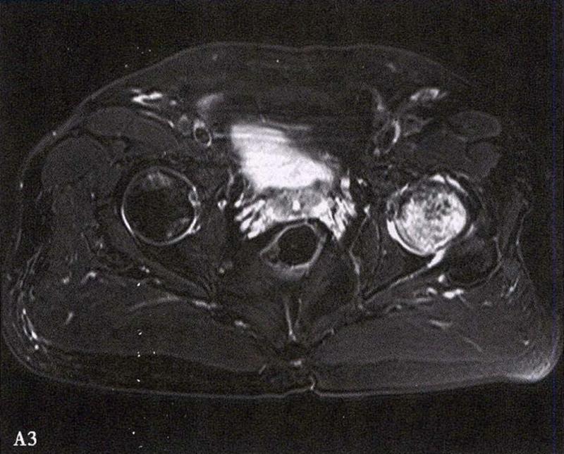 全国十大股骨头坏死诊疗中心,股骨头坏死诊疗方法有哪些