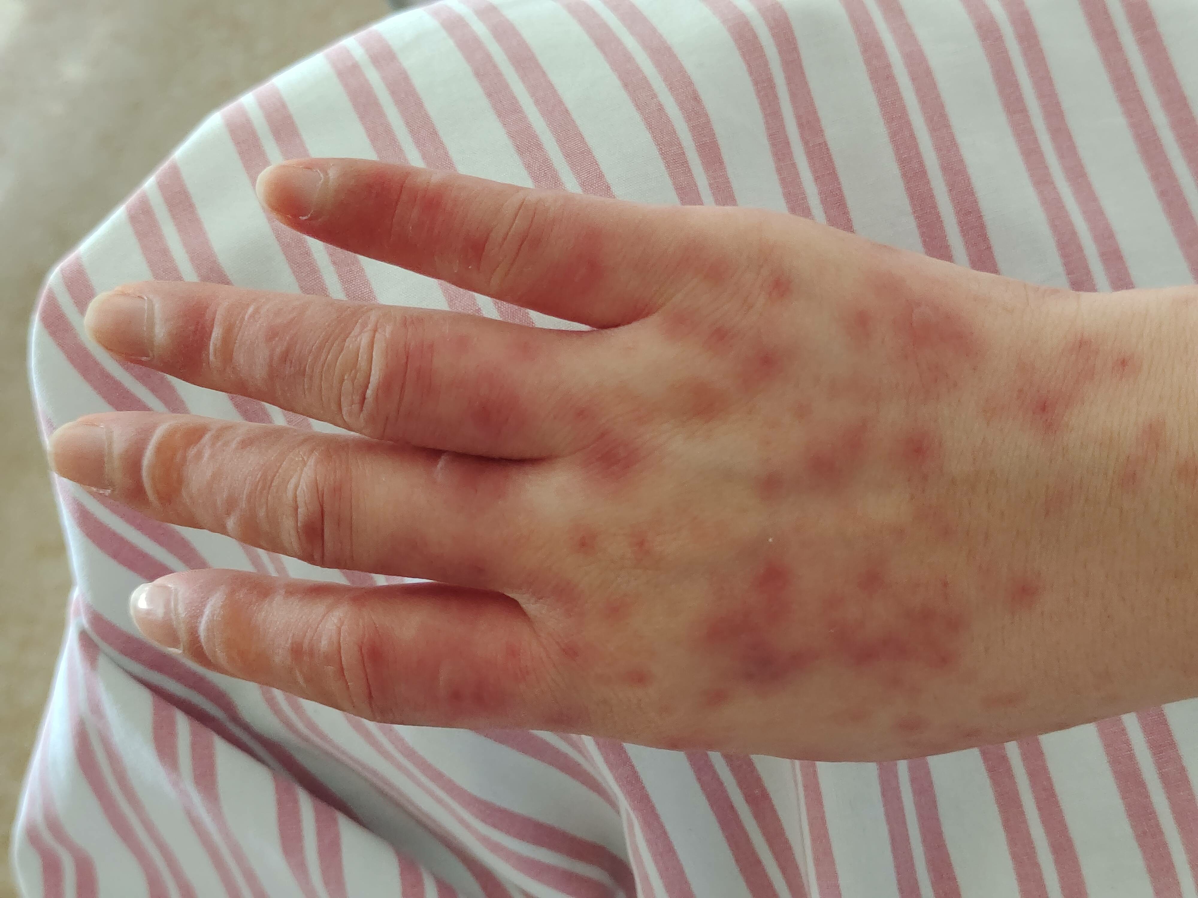 儿童过敏性紫癜可以治愈么,肾性过敏性紫癜可以治愈吗