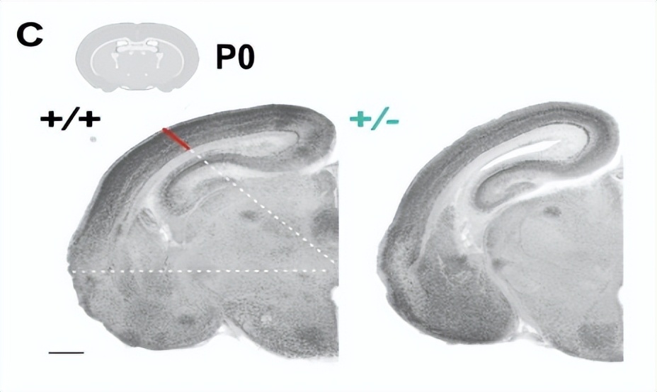 癫痫性精神病特效药,关于难治性癫痫的药物研究进展