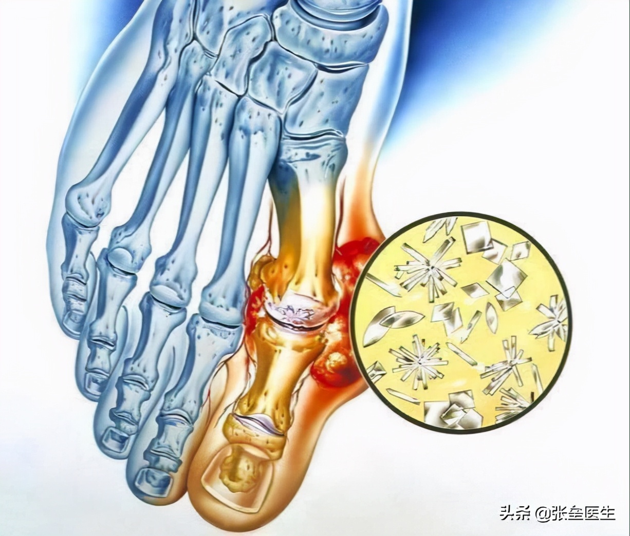 降尿酸医生开了非布司他,尿酸800多吃非布司他管用吗