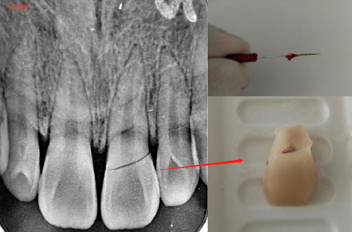 牙齿断了一半怎么处理最好多少钱,牙齿断了一半怕冰怎么处理最好
