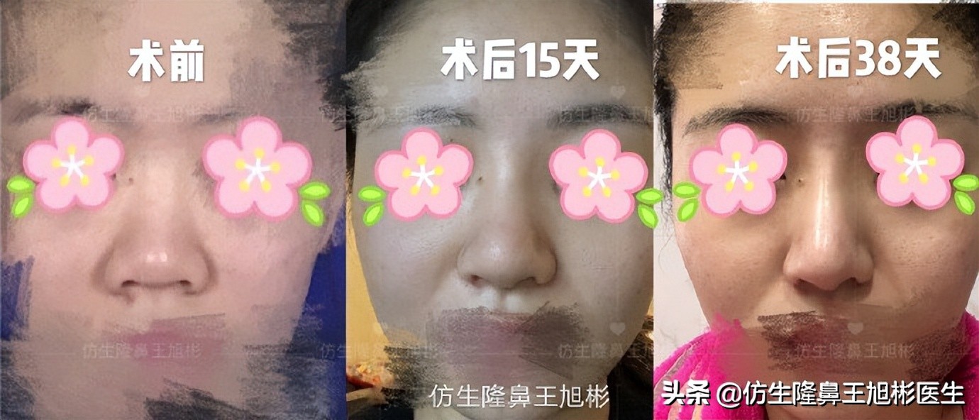 隆鼻鼻头大是失败了吗,大鼻头隆鼻手术案例
