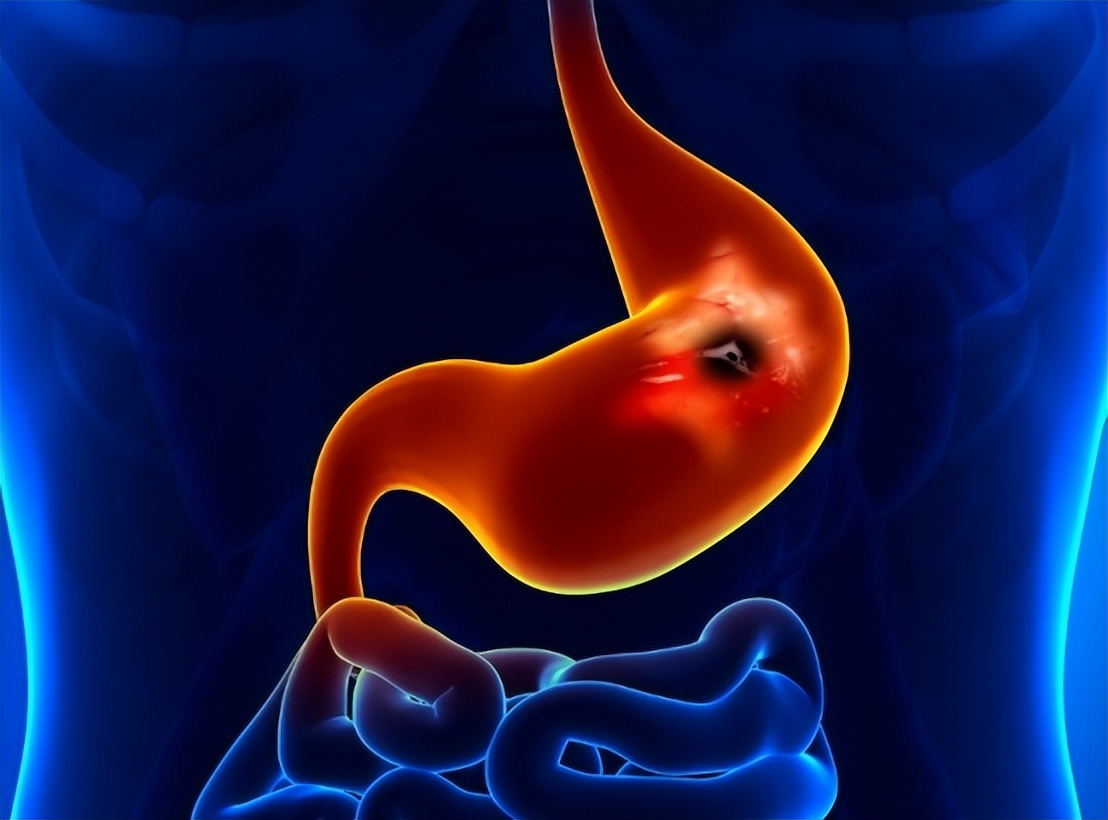 胃穿孔的症状及治疗方法,胃穿孔什么治疗方法好