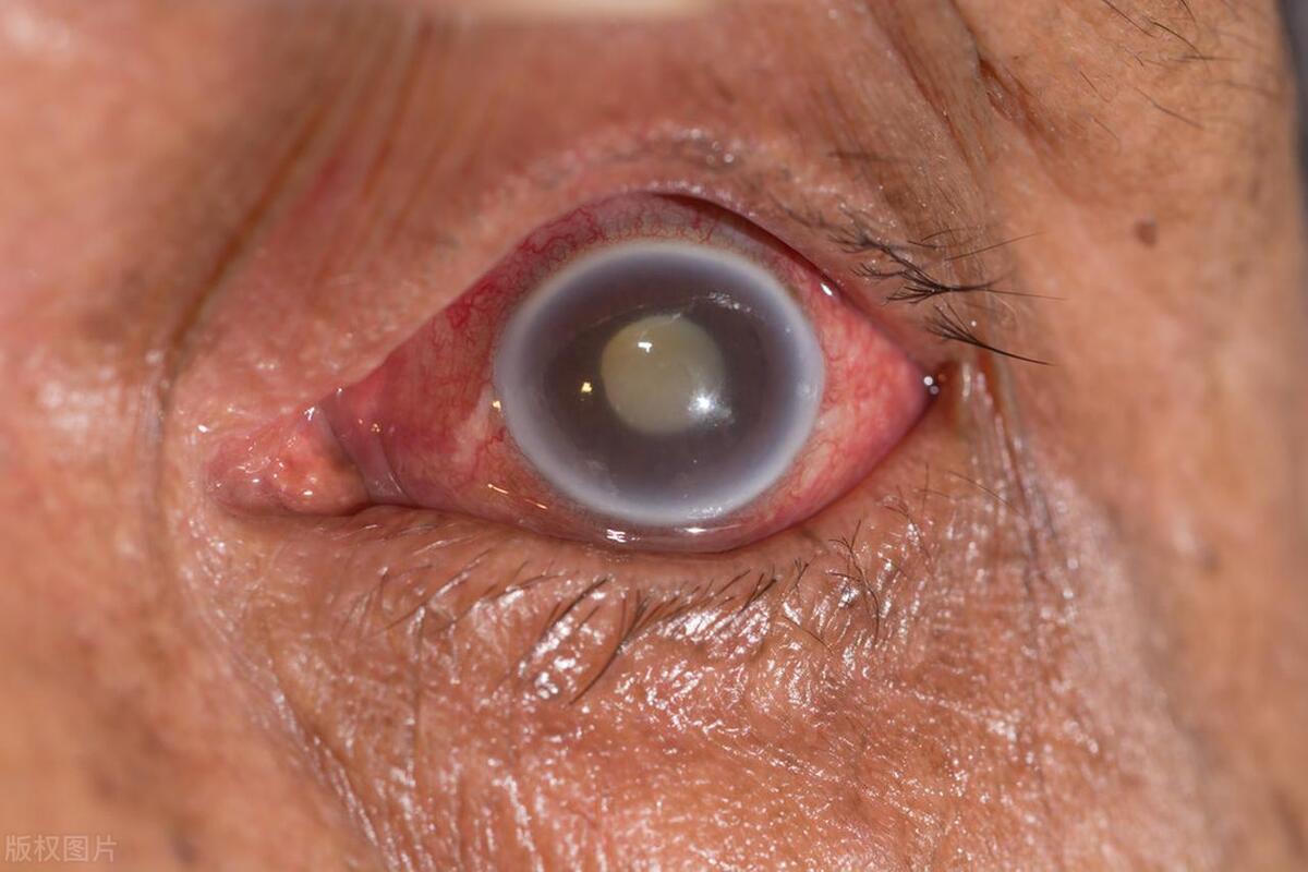 糖尿病伤害到眼睛的症状,糖尿病血糖多高会影响眼睛